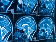 Thuật toán phân biệt tổn thương não: Công cụ mới rút ngắn thời gian chẩn đoán